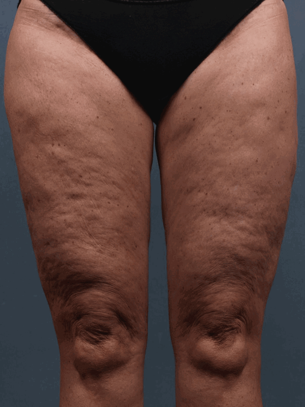 Anti-Cellulite - Resurfacing Body Polish